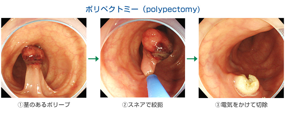 ポリペクトミー（polypectomy)