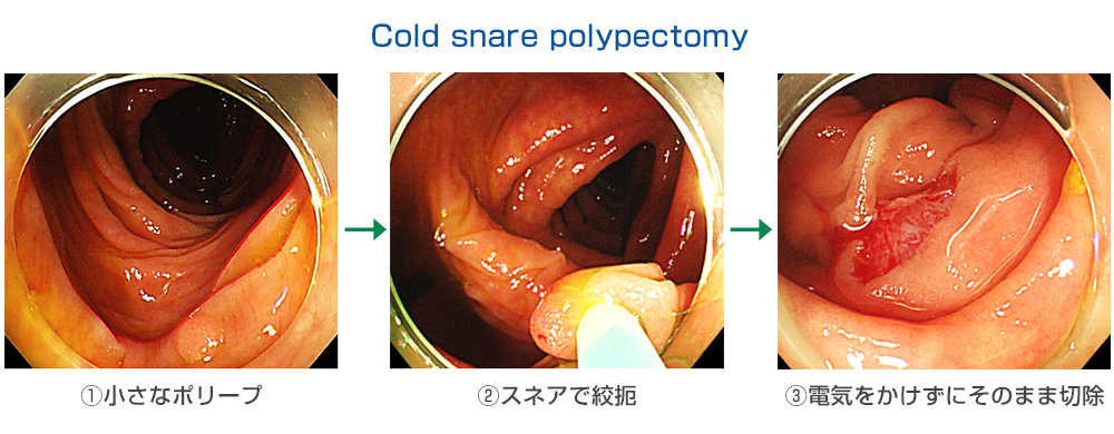 Cold snare polypectomy