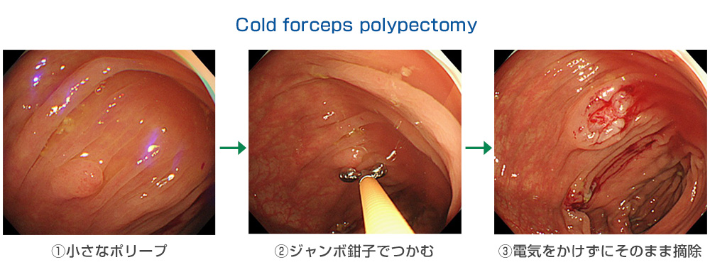 Cold forceps polypectomy