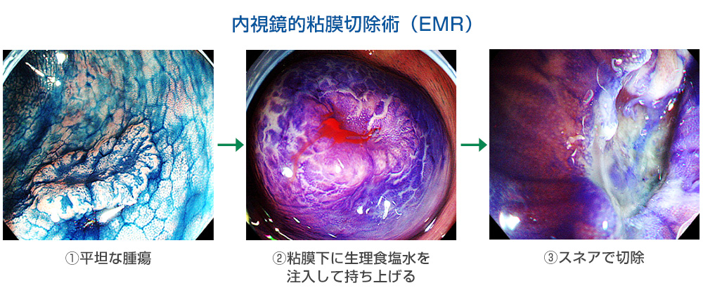 内視鏡的粘膜切除術（EMR）