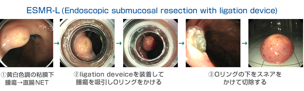 ESMR-L（Endoscopic submucosal resection with ligation device）